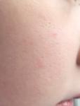 Рубцы на лице от аллергии фото 2