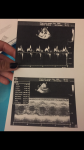 Артериальная гипертензия 2 стадии 3 степени риск ССО высокий фото 3