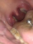Резкая боль в горле, налет на миндалинах фото 1