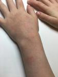 Сыпь или дерматит на руках и щечках фото 2