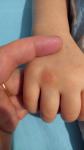 У ребенка на руке пятно телесного цвета фото 3