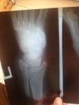 Перелом правой лодыжки или трещина можно ли ходить без костылей фото 2