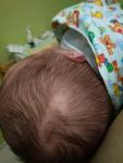 Невус Ядассона у новорожденного фото 1