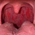 Волдыри в горле, пупырышки, Красные пятна фото 1