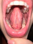 Безболезненные образования в горле телесного цвета фото 1