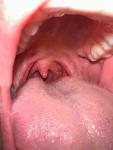 Безболезненные образования в горле телесного цвета фото 3