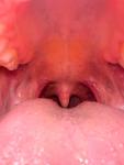 Безболезненные образования в горле телесного цвета фото 4