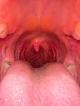 Безболезненные образования в горле телесного цвета фото 5