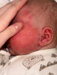 Аллергия или цветение у 1 месячного ребенка фото 2