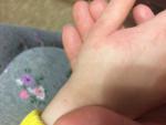 Сыпь между пальцев и на ладонях у ребёнка фото 1