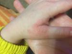 Сыпь между пальцев и на ладонях у ребёнка фото 2