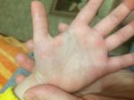 Сыпь между пальцев и на ладонях у ребёнка фото 3