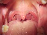 Хронический тонзиллит, боль в горле, воспаление миндалин фото 2