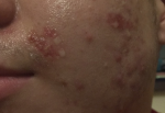 Воспаление кожи, акне, комбинированное лечение фото 2