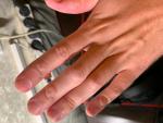 Наросты в районе суставов пальцев руки фото 2