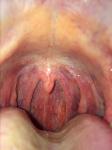 Частые периодические боли в горле фото 2