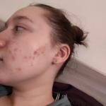 Высыпания на лице, воспаления фото 2