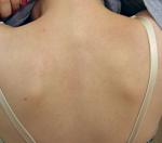 Сыпь и покраснение в области шеи, плеч и спины фото 1