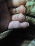 Маленькие волдыри на подушечках пальцев и под ногтем фото 3