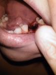 Гранулема зуба 6ка боли в десне и кровь после удаления фото 3