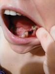 Гранулема зуба 6ка боли в десне и кровь после удаления фото 2
