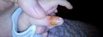 У новорожденного облезла кожа с пальца, палец покраснел фото 1