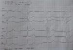 Помогите в постановке диагноза по ЭКГ фото 2