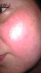 Ужасная сыпь на щеках и красные пятна фото 1