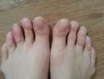 Уплотнение кожи на пальцах ног фото 1