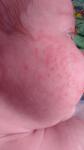 Сыпь на лице грудничка. Акне или аллергия? фото 2