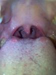 Воспаления на языке и горле фото 1