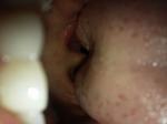 У ребенка в гортани около маленького язычка пузырек фото 1