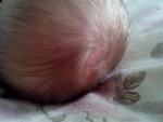 Розовое пятно на голове у грудничка фото 1