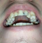 Синие передние зубы фото 3
