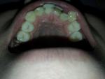 Синие передние зубы фото 2