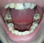 Синие передние зубы фото 1