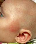 Алергия на голове и лице фото 1