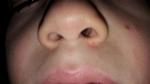 Водянистые высыпания на лице у мальчика 6 лет фото 2