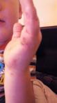 Аллергический дерматит, кожа на пальцах и ладонях зудит и шелушится фото 2