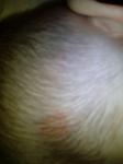 Розовое пятно на голове у ребёнка, шелушится фото 2