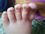Сыпь у ребенка на пальцах рук и ног фото 1