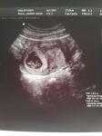 Гематома при беременности фото 3