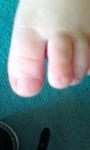 У ребенка черная полоса под ногтем ноги больного пальца фото 1
