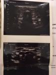 Гипотиреоз и планирование беременности фото 2