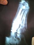 Повторный рентген ноги на 6 день фото 2