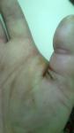 Опухоль после глубокого пореза травой ладони в р-не большого пальца фото 1