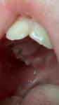Воспаление десны возле запломированого зуба фото 2