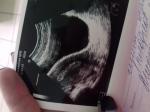 УЗИ раннего срока беременности фото 2