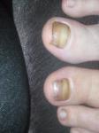 Применение спрея Сангридок при грибке ногтей фото 1