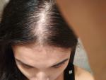 Выпадение волос, результаты анализов фото 3